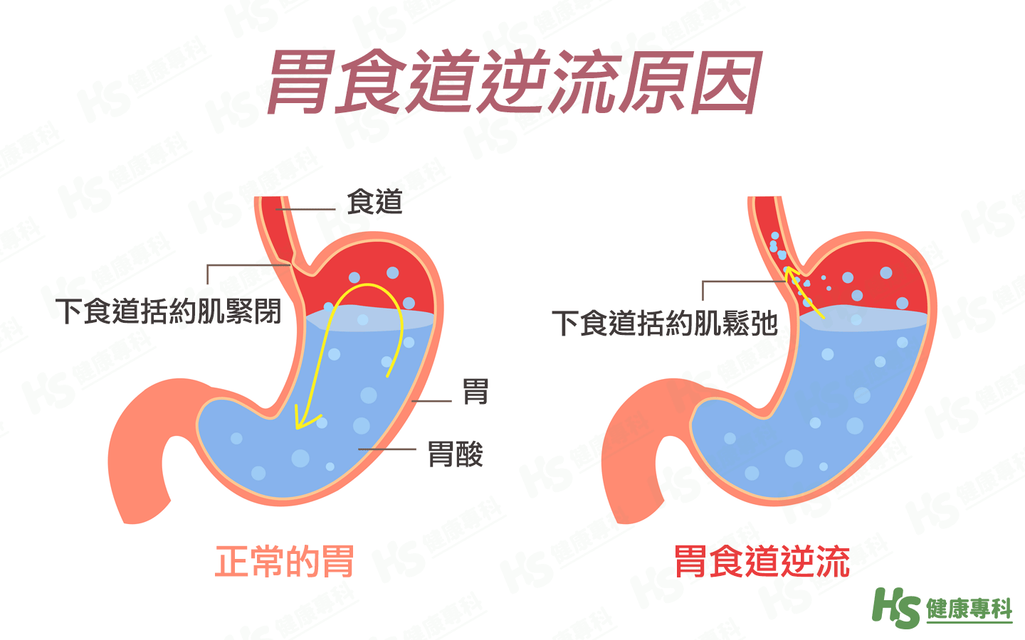 胃食道逆流是什麼？逆流該怎麼辦？2大症狀與治療改善方法-1.png